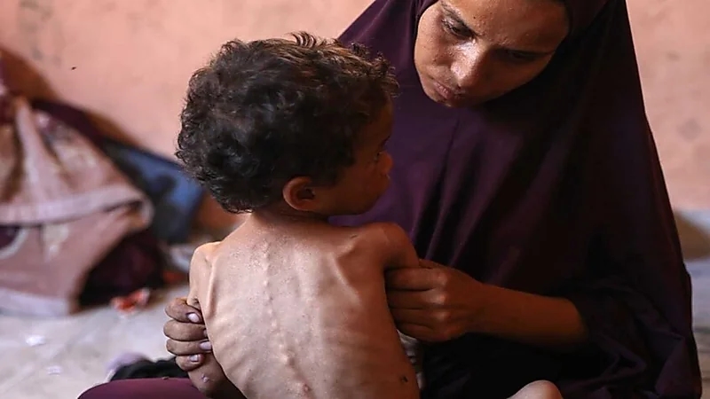 فيروس قاتل يشبه كورونا يهدد حياة الأطفال الجوعى في غزة