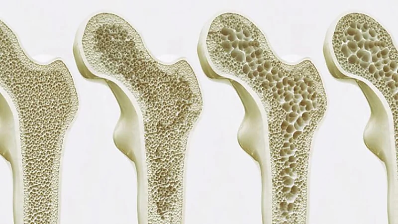 تلوث الهواء يسرع هشاشة العظام وإصابات العمود الفقري