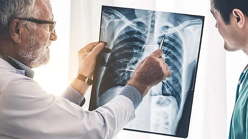 عادات غذائية تزيد من خطر الإصابة بسرطان الرئة