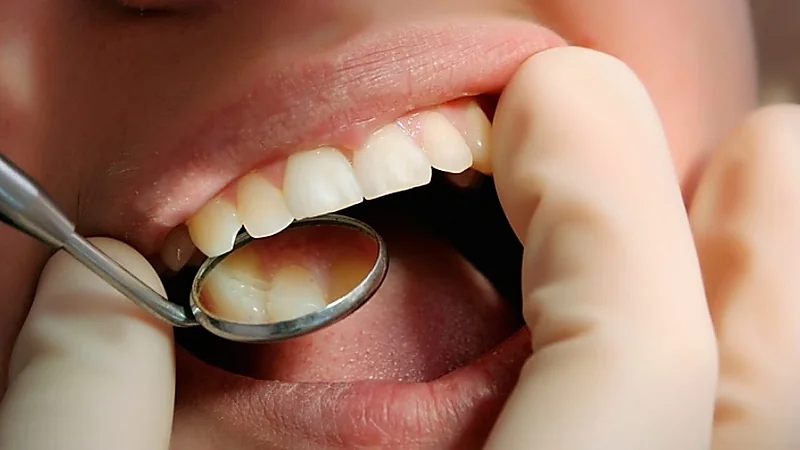 طبيب أسنان يحذر: بكتيريا الفم قد تسبب أمراض القلب والسكري والزهايمر.. فيديو