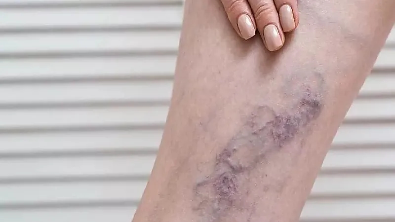 3 أعراض تنذر بالإصابة بالجلطات الوريدية .. فيديو