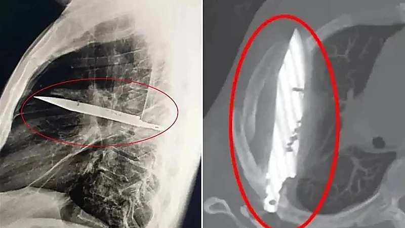 استخراج سكين علق بصدر شاب 8 أعوام