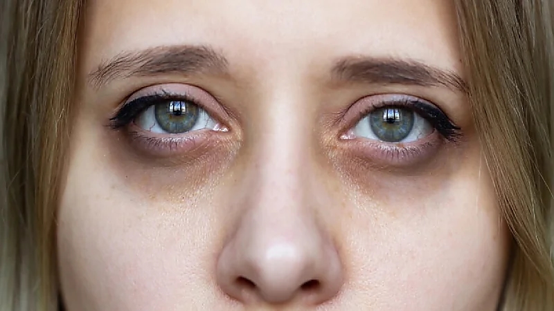 نصائح للتخلص من السواد تحت العين