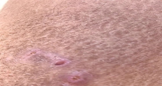 مقيم يتعرض للهجوم من 4 كلاب ضالة بمهد الذهب