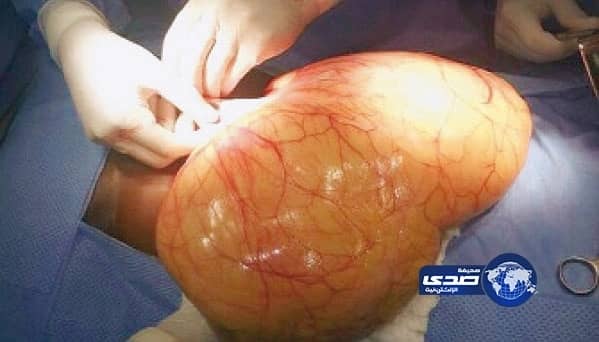 استئصال ورم يزن 10 كيلو من بطن عشرينية في الرياض