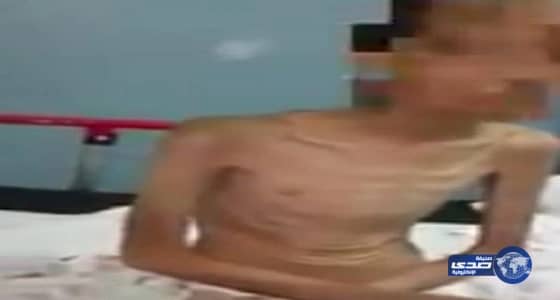 تأهيل المدينة يستضيف الطفل المعنف وإيواء أخته بدار الحماية