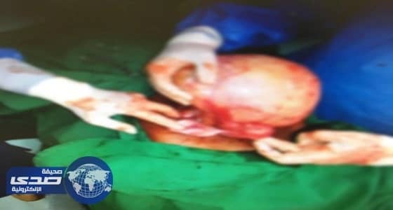 بالصور.. التأهيل الشامل للإناث بجدة يفعل اليوم العالمي للإعاقة