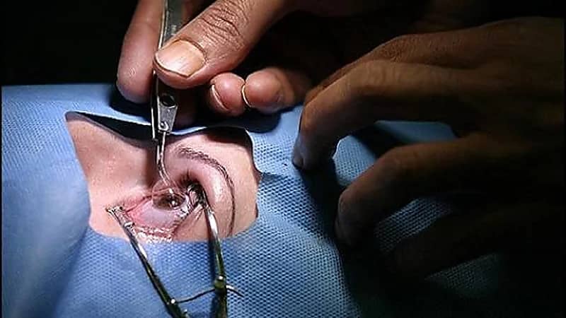 بالفيديو.. استشاري: عمليات الليزر لا تصلح لكل الأشخاص