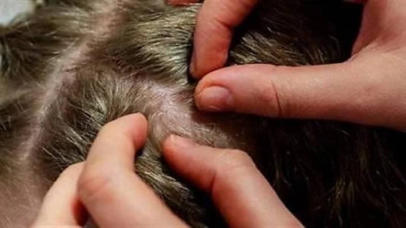 توضيح من "سعود الطبية" عن أسباب العدوى بحشرة القمل