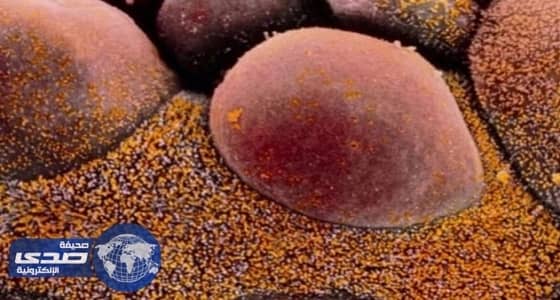 علاج موجّه جديد لسرطان المبيض