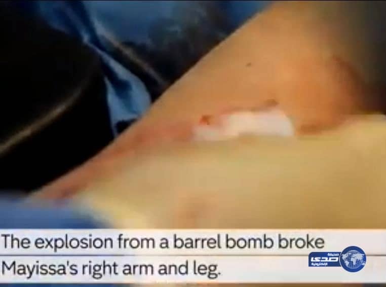 بالفيديو .. ولادة طفل سوري خلال معالجة والدته من إصابات بالغة