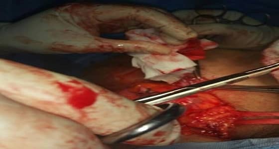 استئصال ورم من مريضا بمستشفى عيون الجواء