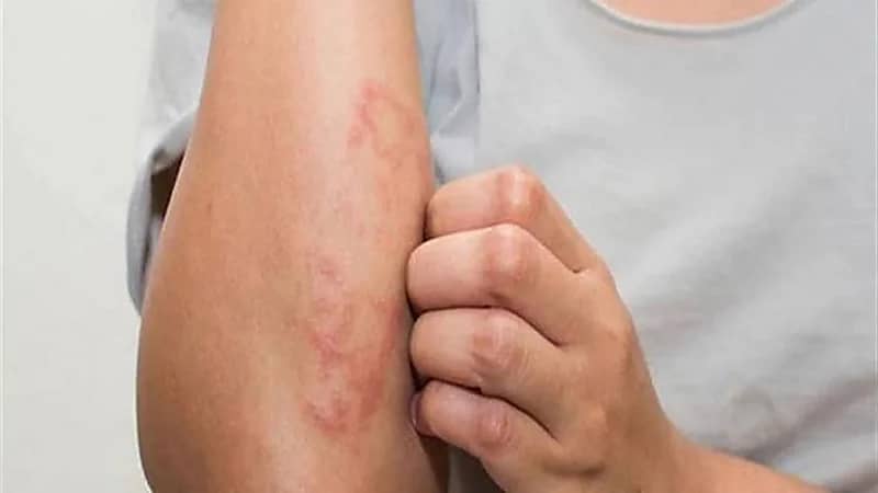 أخصائي تجميل: التشميس لا يمنع الترهلات وزيادته تسبب سرطان