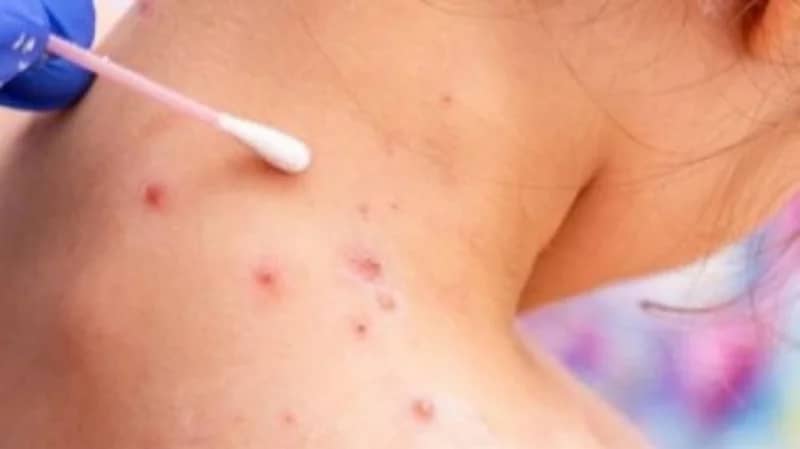 دراسة تكشف أعراض جديدة لجدري القرود