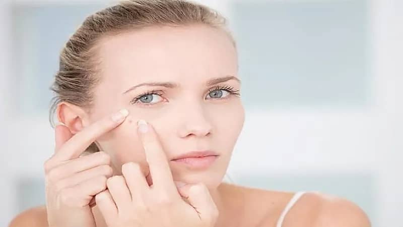 مفاهيم خاطئة عن حب الشباب وواقي الشمس