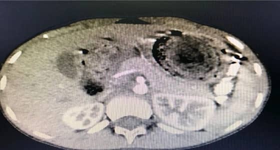 إجراء أول جراحة منظار بالقصيم لاسئصال كتلة محسوسة بمعدة طفل