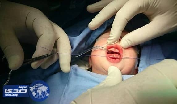 بالصور.. إنهاء معاناة رضيعة من تشوه خلقي نادر بمستشفى الولادة بنجران