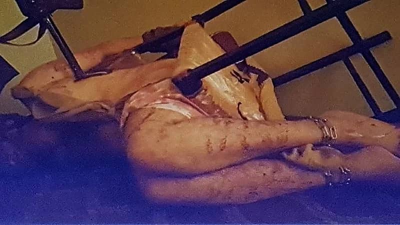 بالصورة.. يمني يُصاب بالشلل بعد تعرضه للتعذيب من الحوثيين