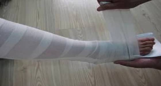 التحقيق في واقعة وضع جبيرة بشكل خاطئ كادت تبتر قدم مريض