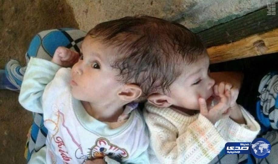 خادم الحرمين يأمر بعلاج التوأم المصري الملتصق «منة ومي»