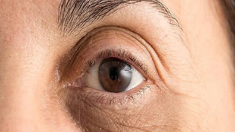 أسباب ظهور الهالات السوداء وكيفية ‏العلاج