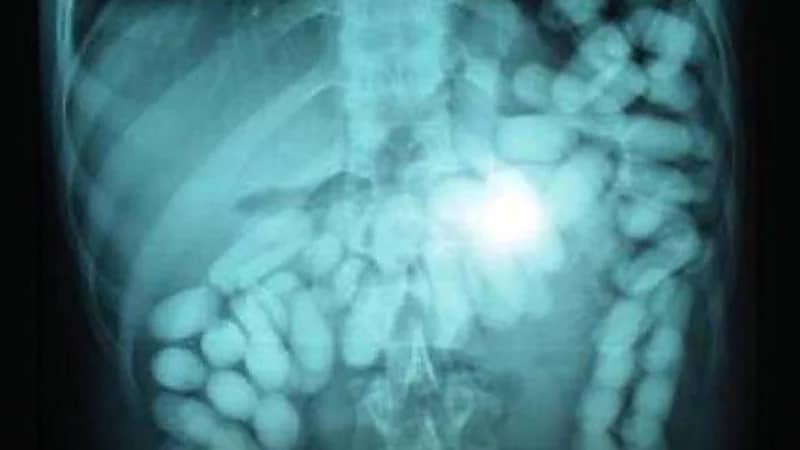 الأردن‬⁩ تضبط مسافر ابتلع 826 حبة كبتاجون ليتمكن من تهريبها إلى المملكة