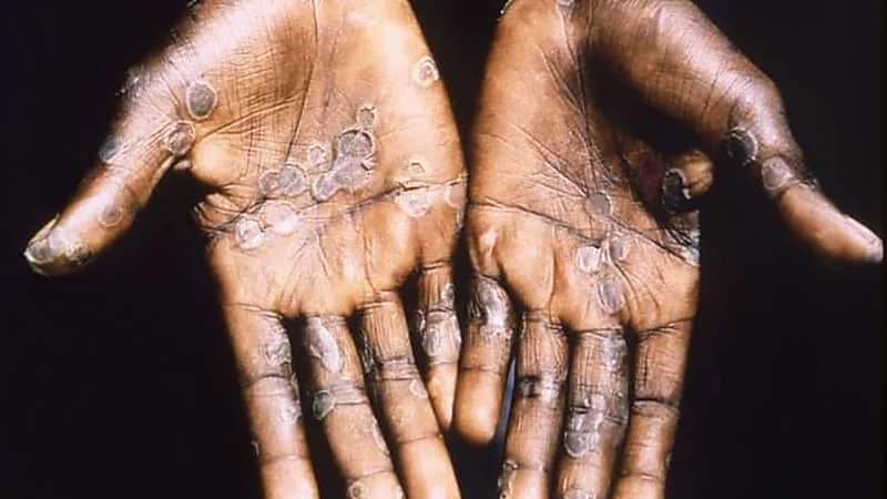 الصحة الإماراتية: رصد أول إصابة بجدري القردة لزائرة من غرب أفريقيا