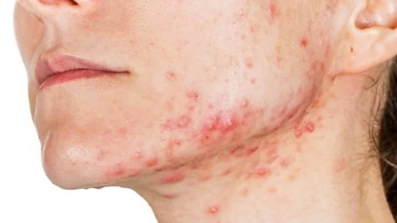 علاجات سريعة للتخلص من حب الشباب