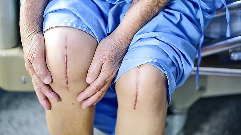 شاهد .. تقنية جديدة لعملية "استبدال الركبة" تخفف الألم وتحقق نتائج مبهرة