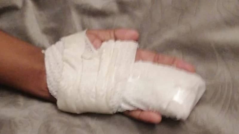 طالب يفقد أحد أصابعه في حادث مدرسي بجازان