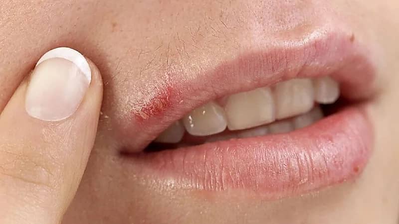 أسباب ظهور تقرحات الفم واللثة وطرق علاجها