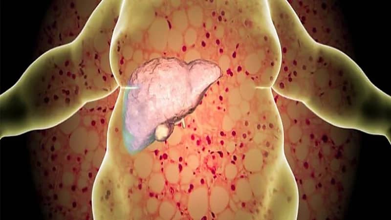 الذيابي: دهون الكبد مرض صامت لا يسبب عادةً أعراض