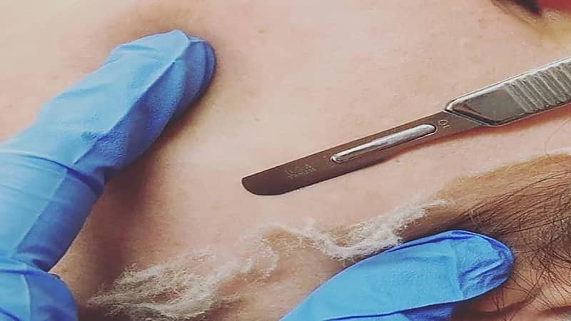 فتاة تتعرض لمشكلة جلدية كبيرة بسبب استخدام الديرما بلانينج