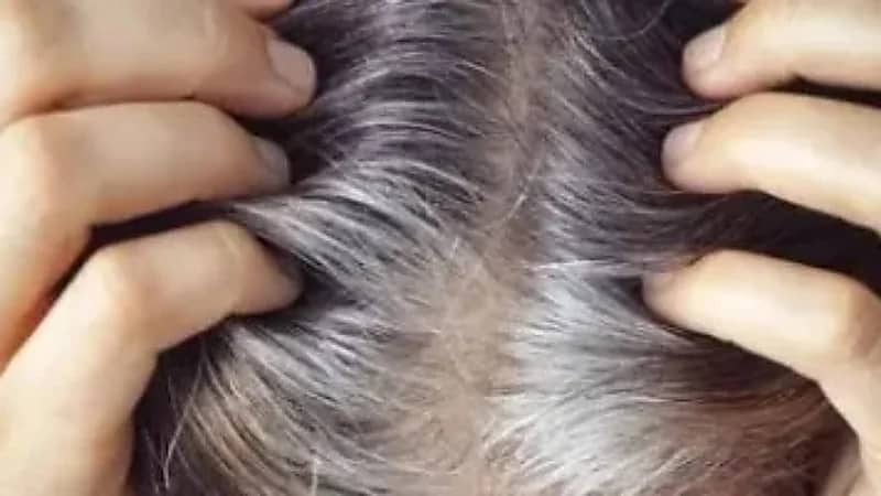 الشيب المبكر: مؤشر صحي لا يجب تجاهله