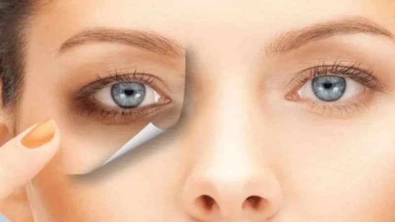 وصفات طبيعية للتخلص من الهالات السوداء