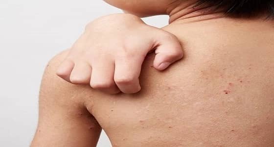 اكتشاف 42 حالة جديدة مصابة بـ " الجرب " بابتدائية في مكة