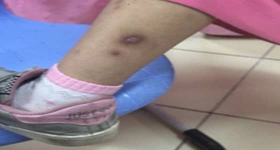 انتشار الجرب بالرياض يثير قلق المواطنين