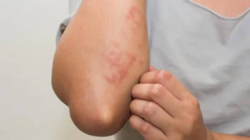 "وقاية" تقدم عدة نصائح للوقاية من جدري القرود