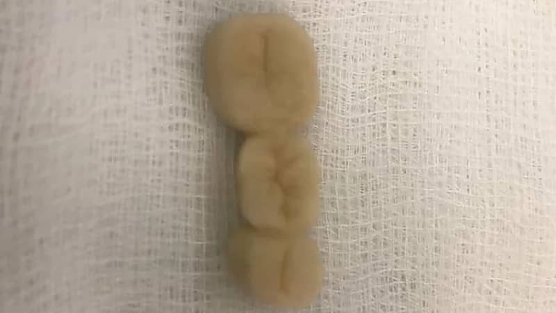 فريق طبي بمكة المكرمة ينقذ مواطنًا ابتلع طقم أسنان