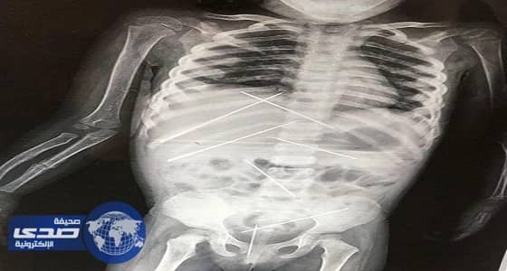 بالصور.. مسن هندي يغرس 7 إبر بجسد طفلة لمعالجتها من السحر الأسود