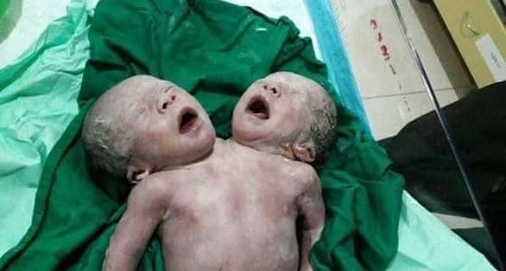 بالفيديو.. ولادة طفل برأسين وجسد واحد