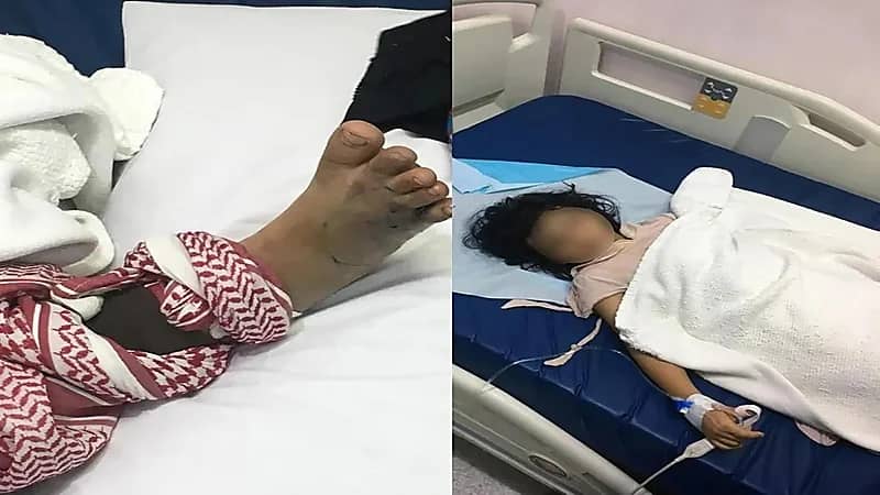 تطورات الحالة الصحية للطفلة التي لدغتها أفعى سامة في نجران