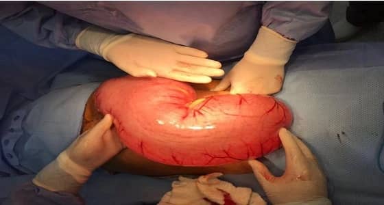 فريق طبي بتخصصي الطائف ينجح في إعادة تحرير الأمعاء لشاب