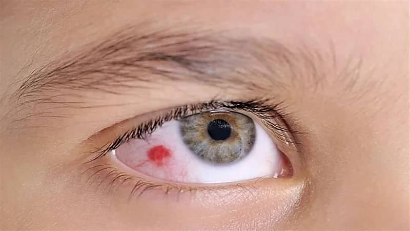 البقع الحمراء في العين تنذر بارتفاع ضغط الدم