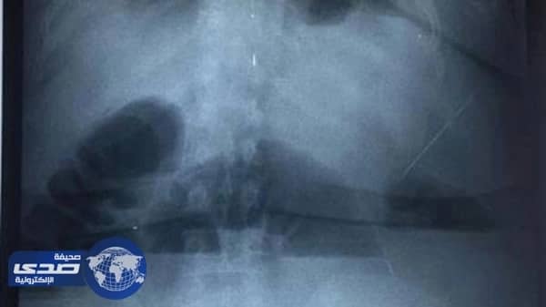 عراقية تتناول المناديل الورقية يومياً لخفض وزنها