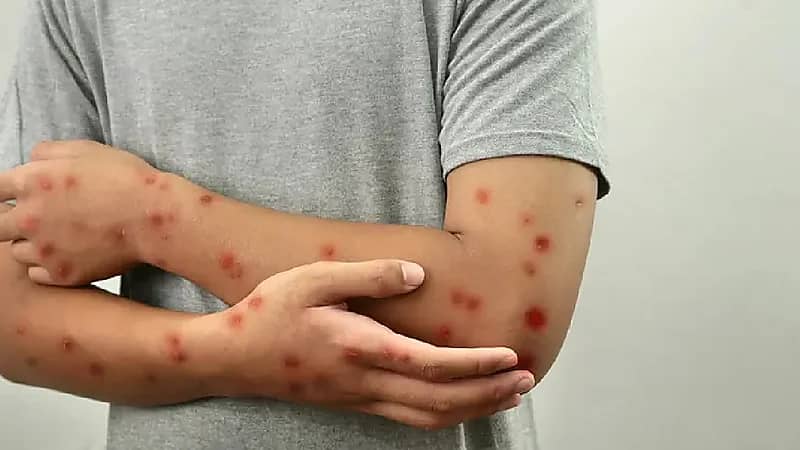 تسجيل أول حالة إصابة بجدري القردة في المغرب