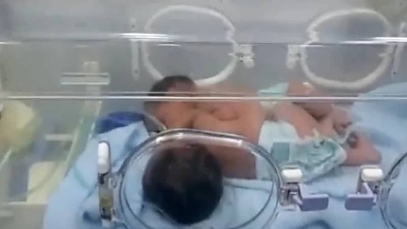 شاهد.. الصور الأولى للتوأم السيامي اليمني "مودة ورحمة "