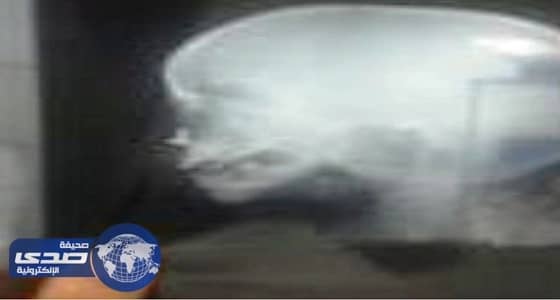 استخراج مسمار من أنف طفلة بمستشفى الأسياح