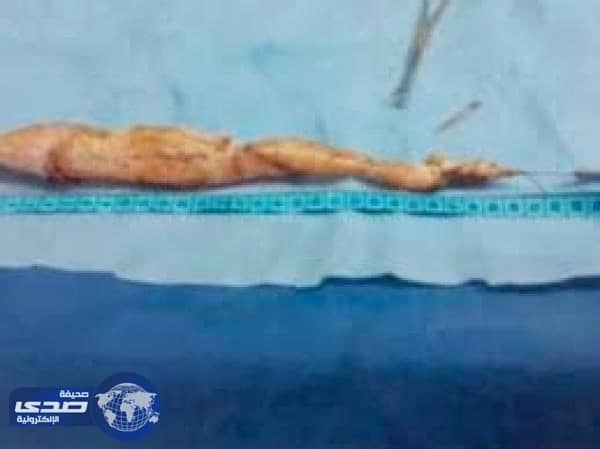 بالفيديو: لأول مرة تسجيل إزالة أطول مرارة في العالم بموسوعة غينيس