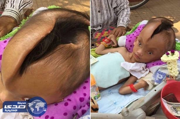 بالفيديو..شق عميق بجمجمة طفل يثير حيرة الأطباء